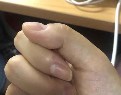 有和我一样指甲是凹进去的姐妹吗!