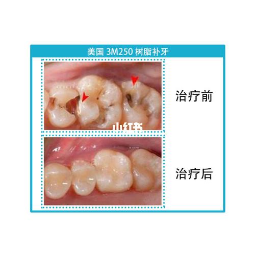 补牙一般多少钱一颗_补牙_合金_蛀牙_口腔_牙疼_医疗健康_医疗健康