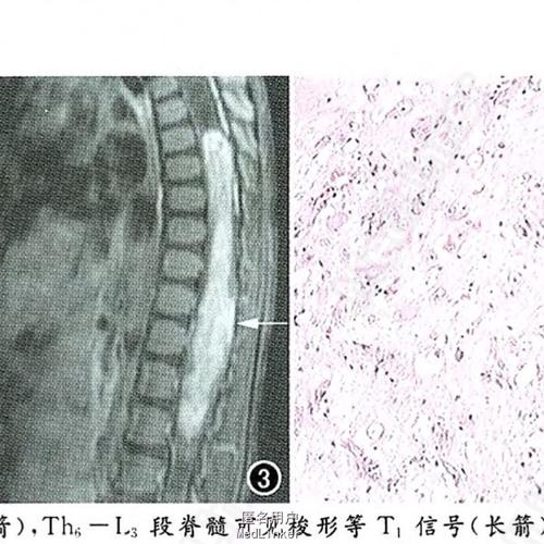 脊髓节细胞胶质瘤