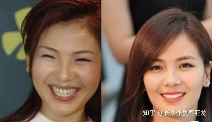 想要牙白就得做明星同款7171