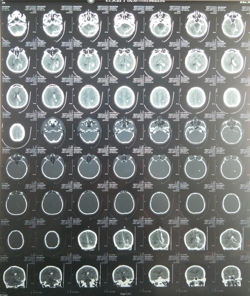 病例分享急诊开颅手术拯救一位重型开放性颅脑损伤患者