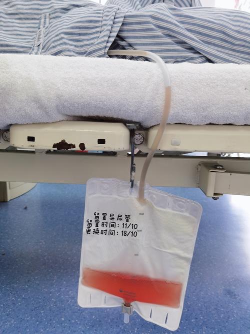 留置导尿的注意事项