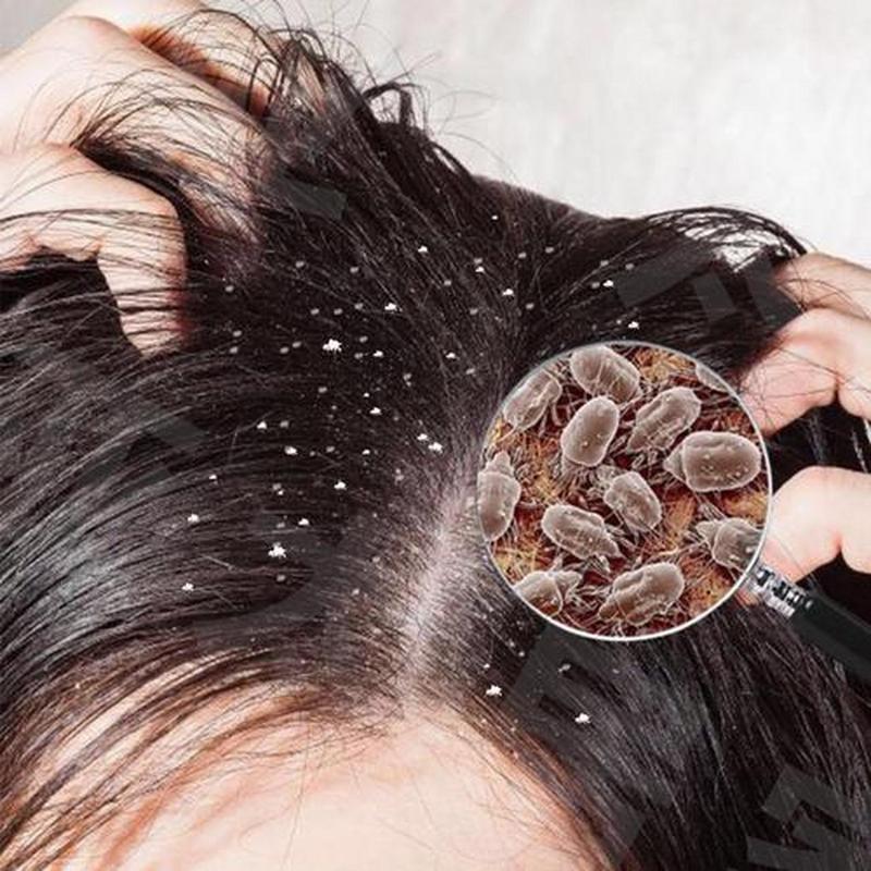 医院里的那些事# 孩子头上长了虱子怎么办?如何有效防治?