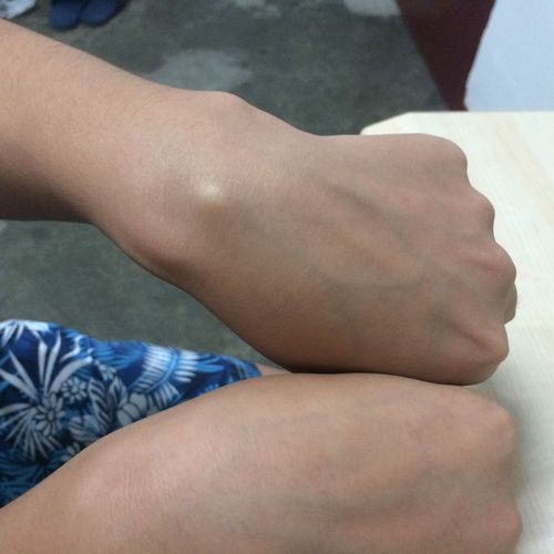手背鼓个小包,摸着也不疼,貌似是骨头凸起还是什么,请问究竟是怎么