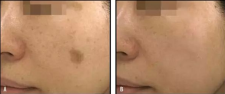 雀斑和黄褐斑的区别 雀斑和黄褐斑图片