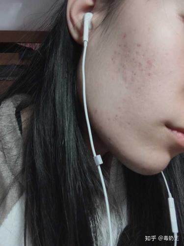 怎么祛除痘印 痘坑?