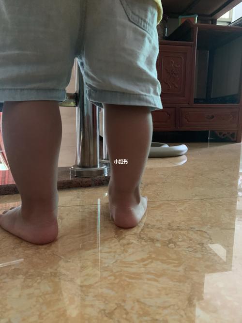 这是足外翻吗?帮忙看下孩子的脚有问题吗?