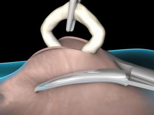 男人结扎后有什么影响?