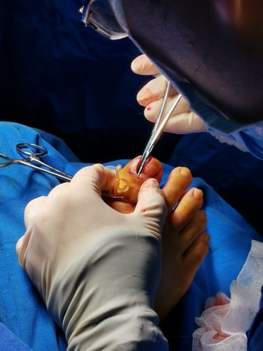 甲沟炎的形成和手术