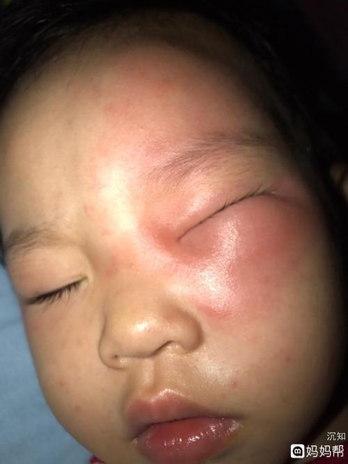 宝宝被蚊子咬到眼睛,肿成一条缝了!