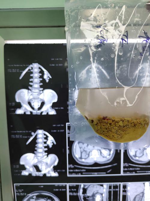 充满型肾铸型结石的微创手术治疗