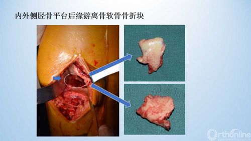 华西经验右膝关节内侧旋转脱位伴骨折病例分享一例