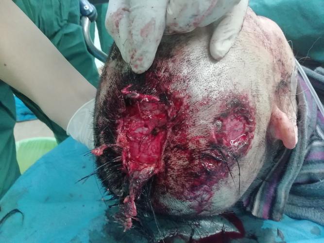 9床车祸伤导致头皮撕裂伤伴局部缺损