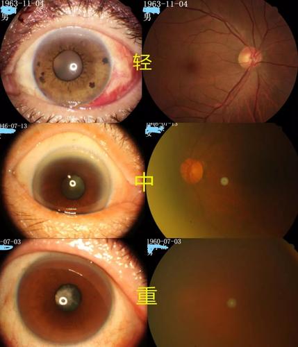 如何判断自己的白内障是在什么程度,该不该手术?