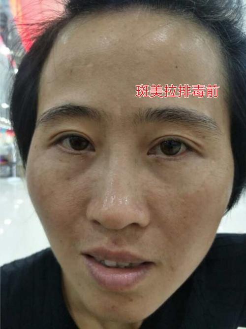 一套斑美拉"脸部排毒"带给我的改变