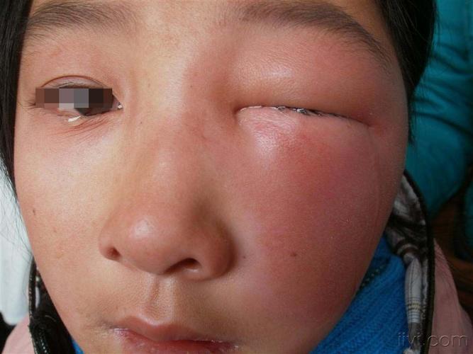 左面部红斑,肿胀,伴发热2天.白细胞:22.44*10.   住院4天.