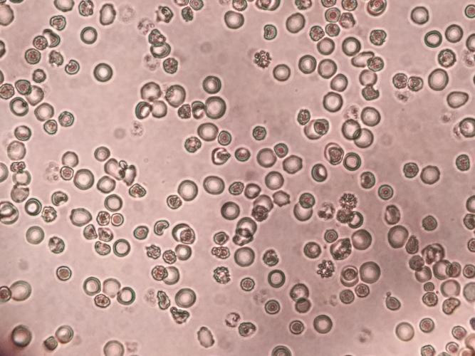 高倍镜下细胞形态,以红细胞为主,红细胞大小不一,可见皱缩红细胞.