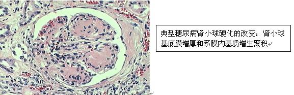 本文患者肾穿组织肾小球系膜细胞和基质轻度增生,主要
