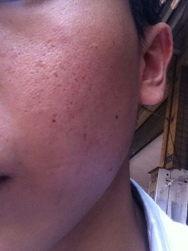 脸上这些坑坑洼洼的痘印怎么修复?要用什么牌子的化妆品或药膏?