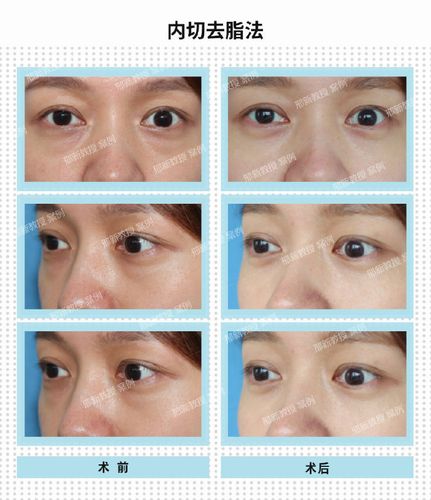 什么是内切单纯去眼袋呢?