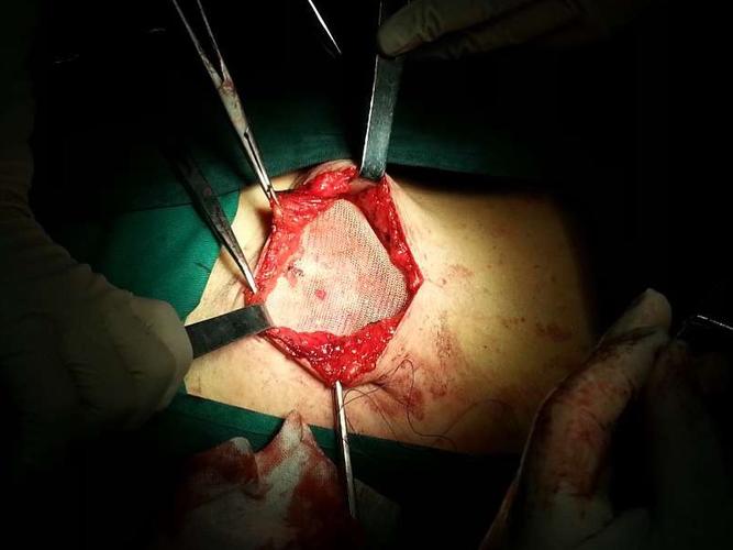 包医一附院普外一科新技术--腹壁切口疝修补术