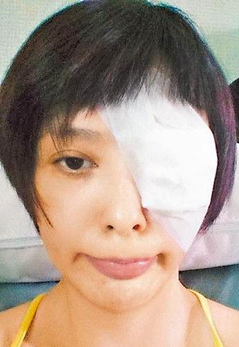 萧淑慎左眼眼球表面撕裂