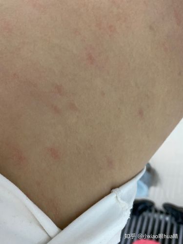 记录玫瑰糠疹恢复的过程