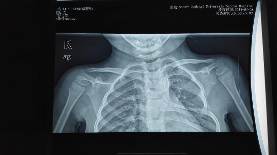 先天性高肩胛症如何诊断和治疗