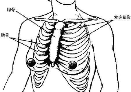 肋软骨炎是什么病