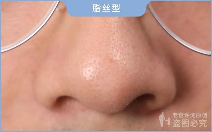 黑头究竟要怎么去我们拔出并放大了四种类型的黑头