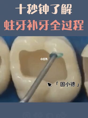 十秒了解龋齿补牙全过程_补牙_口腔_口腔健康_蛀牙_医疗健康_医疗健康