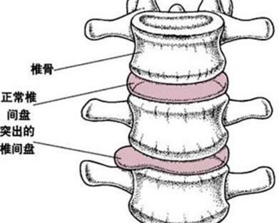 周围小肌肉拉伤,对椎间盘会有不利影响,可能会导致椎间盘突出症状加重