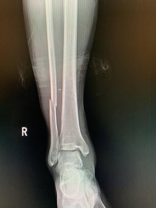术前x片可见踝关节损伤,腓骨高位损伤,下胫腓分离,距骨外移,后踝骨折