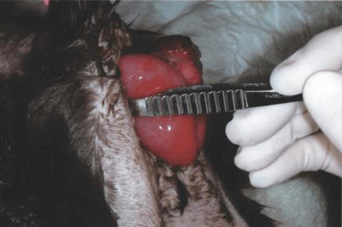 与直肠脱出不同,手指或器械的钝端可轻易地通过脱出的套叠组织和肛门