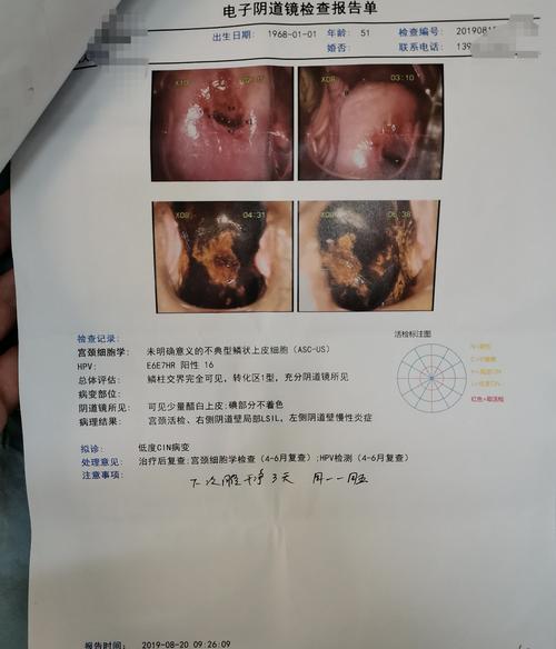 阴道镜图像:提示宫颈上皮内瘤变