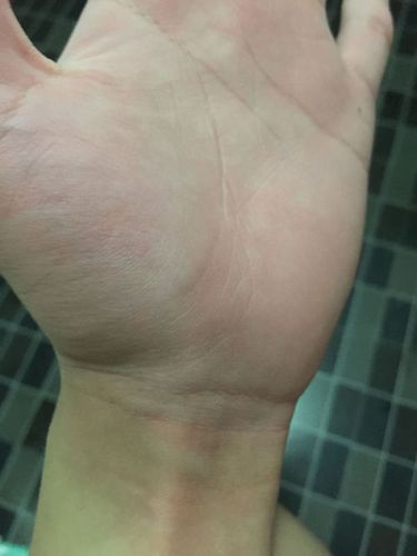 左手掌靠大拇指边有根血管凸起硬硬的 跳动而且有压痛