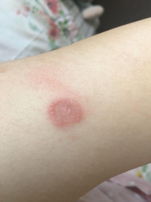 到医院说是玫瑰糠疹,开了一些药,但感觉