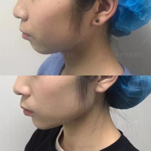 玻尿酸填充下巴前要注意颏肌放松