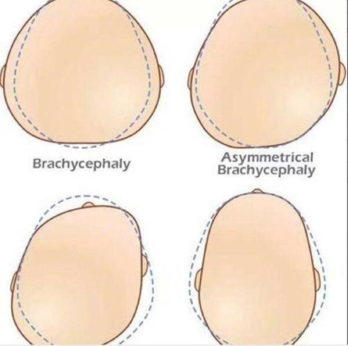 怎么看宝宝是否方颅方颅图片和正常对比参照