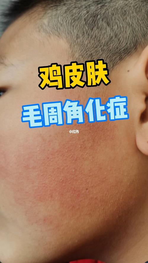 鸡皮肤,毛周角化症_鸡皮肤_长垣县人民医院自由行热门