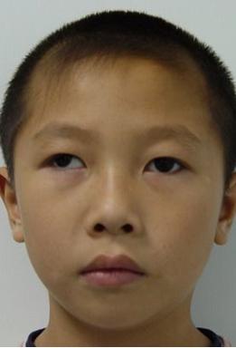 一只眼睛斜视分享展示