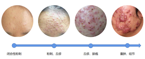 青春痘过了青春期真的就会好吗青春痘真的不需要治疗吗错错错看情况