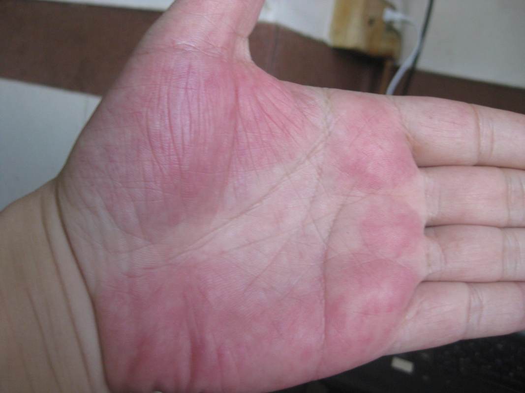 求教:手掌泛红(如图)是什么病?谢谢.