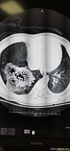 肺囊腺瘤:今天遇到一个罕见病例给大家分享一下!