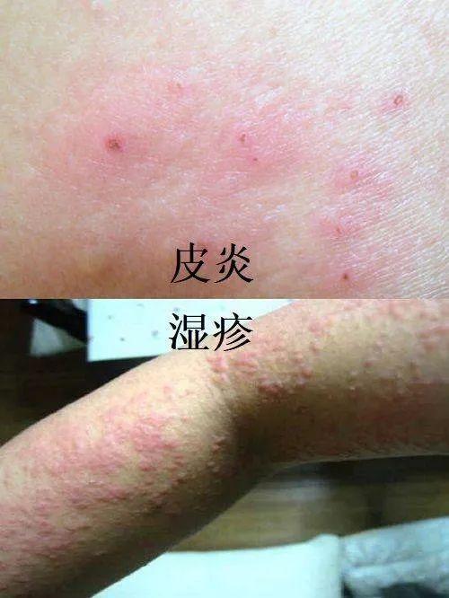 皮炎和湿疹的区别70 皮炎病程短,复发少;湿疹病期长,缠绵难愈.