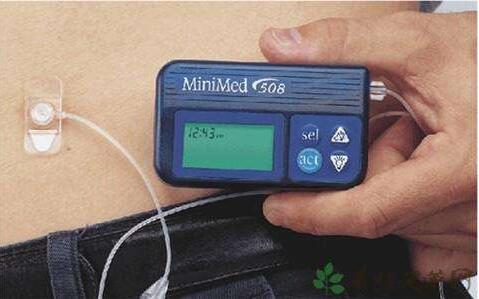 胰岛素泵的使用方法?