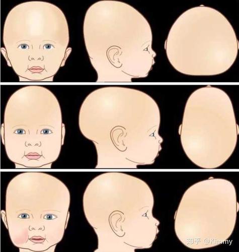 俗称"大小脸"可参照下图来理解. 1.