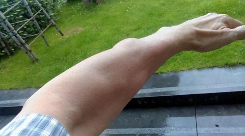 关注| 究竟什么是脂肪瘤?不治疗会自行消失吗?会不会癌变?