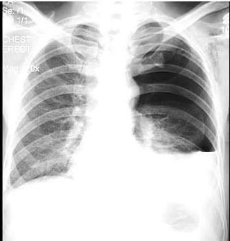 男,32岁,2天前被人踢伤胸部,感胸闷,呼吸困难,x线检查如图,最可能的