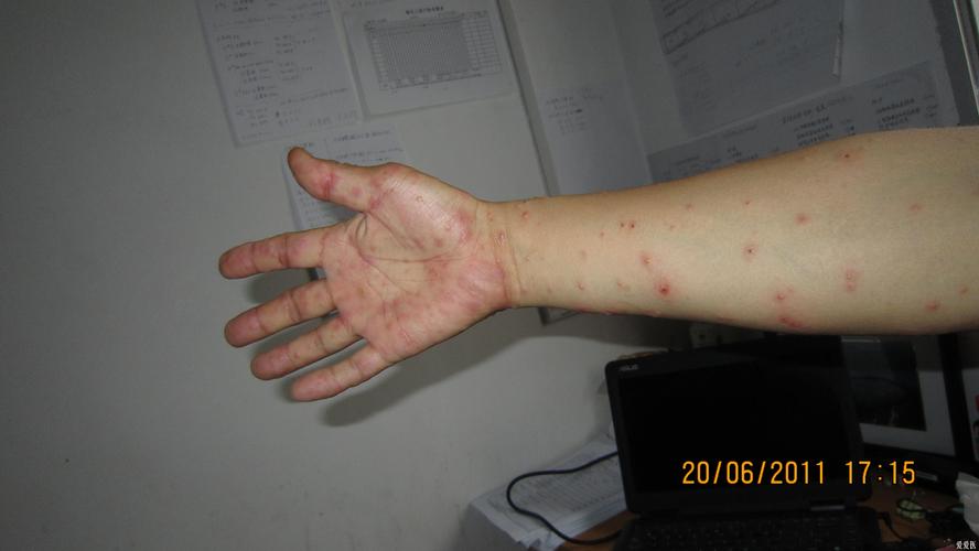 我治疗的一个很典型的多形红斑病人图片